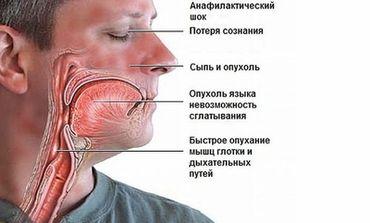 Неотложная помощь при анафилактическом шоке